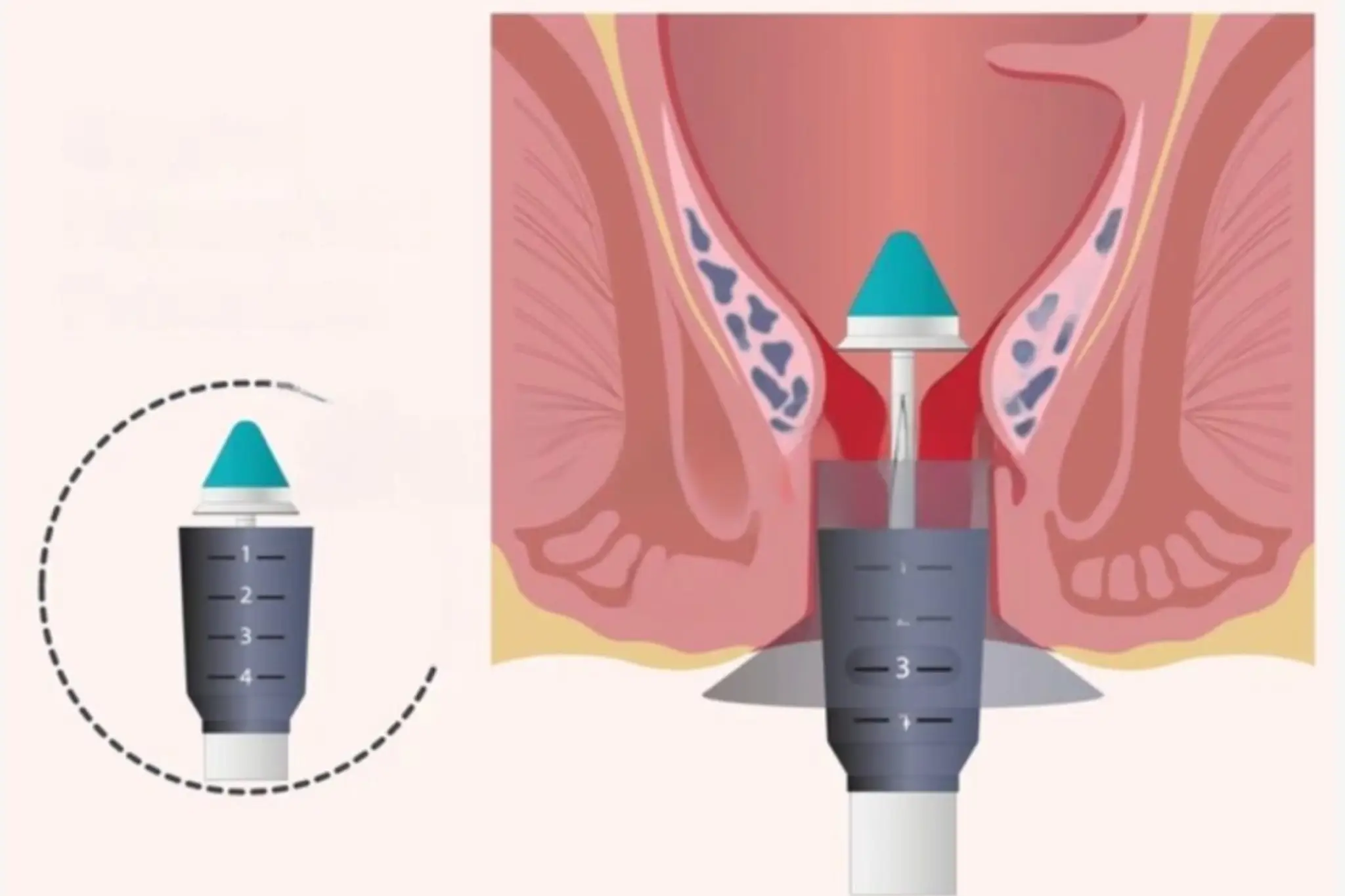 Stapler Piles Surgery in Pune